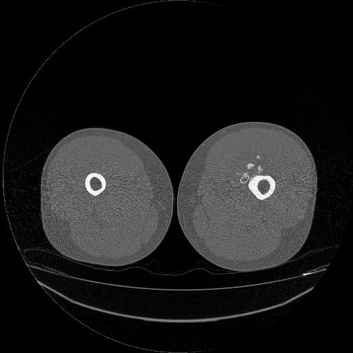 File:Chondrosarcoma arising from exostosis (Radiopaedia 59996-67507 Axial bone window 2).jpg