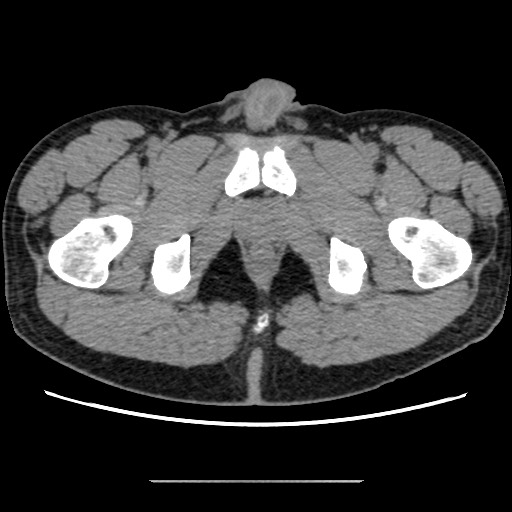Chondrosarcoma of iliac wing (Radiopaedia 63861-72599 Axial non-contrast 118).jpg