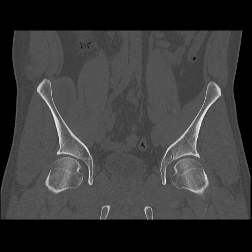 Chondrosarcoma of iliac wing (Radiopaedia 63861-72599 Coronal bone window 53).jpg