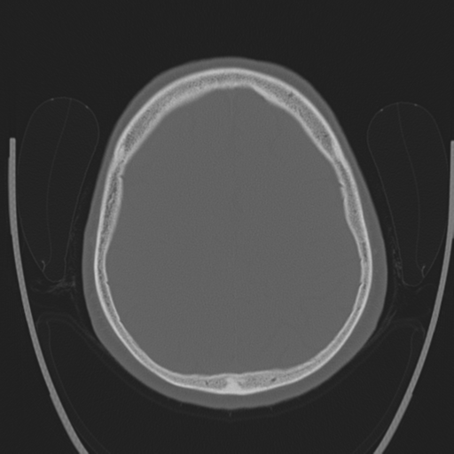 Chondrosarcoma of skull base- grade II (Radiopaedia 40948-43653 Axial bone window 36).png