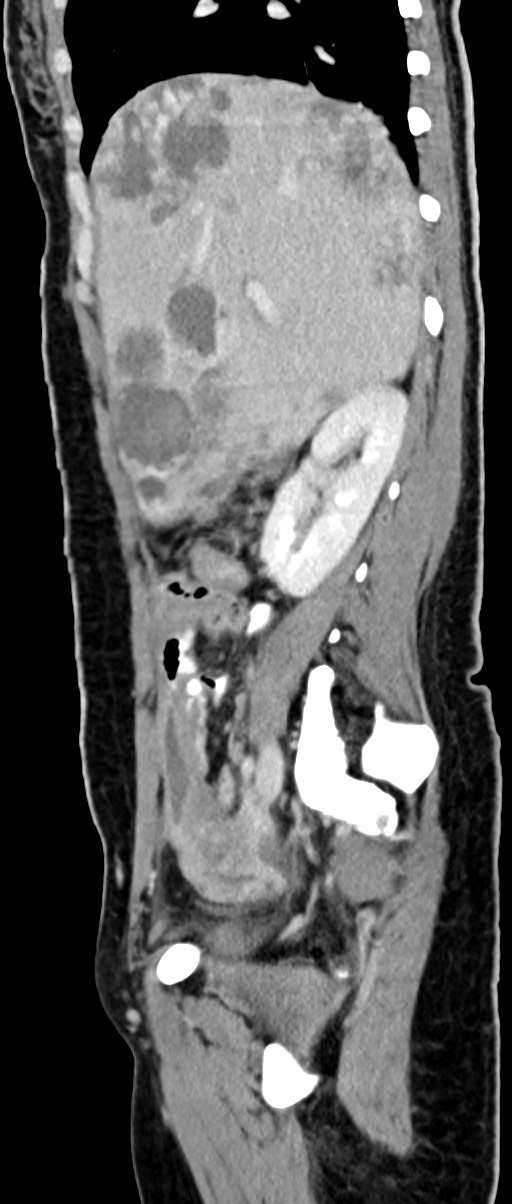 Choriocarcinoma liver metastases (Radiopaedia 74768-85766 C 120).jpg