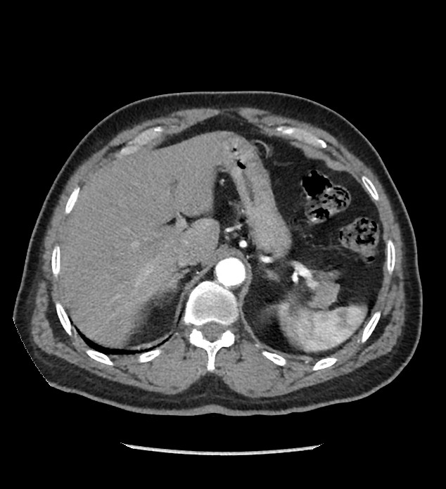 Chromophobe renal cell carcinoma (Radiopaedia 86879-103083 B 34).jpg