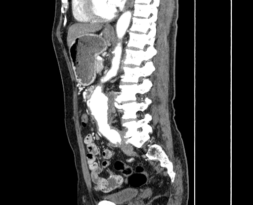 File:Chronic contained rupture of abdominal aortic aneurysm with extensive erosion of the vertebral bodies (Radiopaedia 55450-61901 B 41).jpg