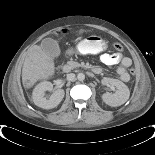 Chronic diverticulitis complicated by hepatic abscess and portal vein thrombosis (Radiopaedia 30301-30938 A 42).jpg