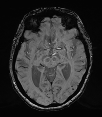 Chronic hypertensive encephalopathy (Radiopaedia 39993-42482 Axial SWI 39).png