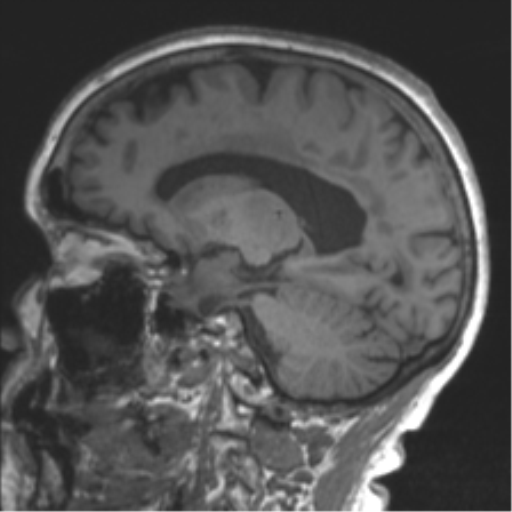 File:Chronic hypertensive encephalopathy (Radiopaedia 39993-42482 Sagittal T1 57).png