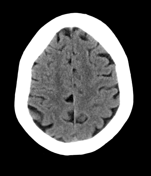 File:Chronic hypertensive encephalopathy (Radiopaedia 39993-42485 Axial non-contrast 26).png