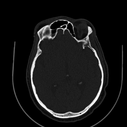 File:Chronic invasive fungal sinusitis (Radiopaedia 91563-109286 Axial sinus 122).jpg