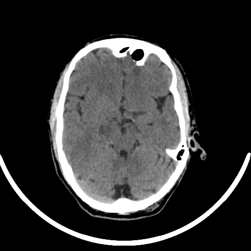 File:Chronic invasive fungal sinusitis with intraorbital and intracranial extension (Radiopaedia 56387-63046 Axial non-contrast 168).jpg