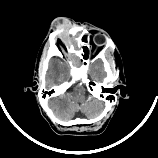Chronic invasive fungal sinusitis with intraorbital and intracranial extension (Radiopaedia 56387-63046 B 105).jpg