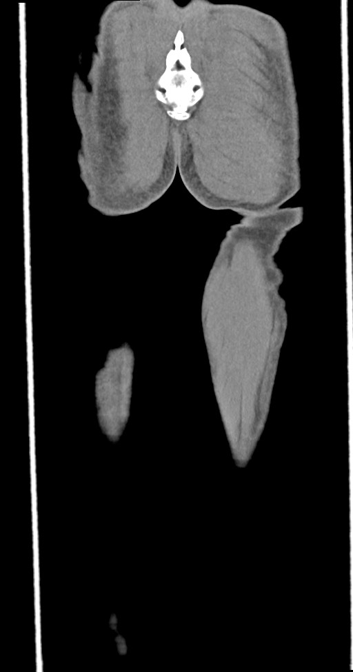 Chronic osteomyelitis (with sequestrum) (Radiopaedia 74813-85822 E 54).jpg