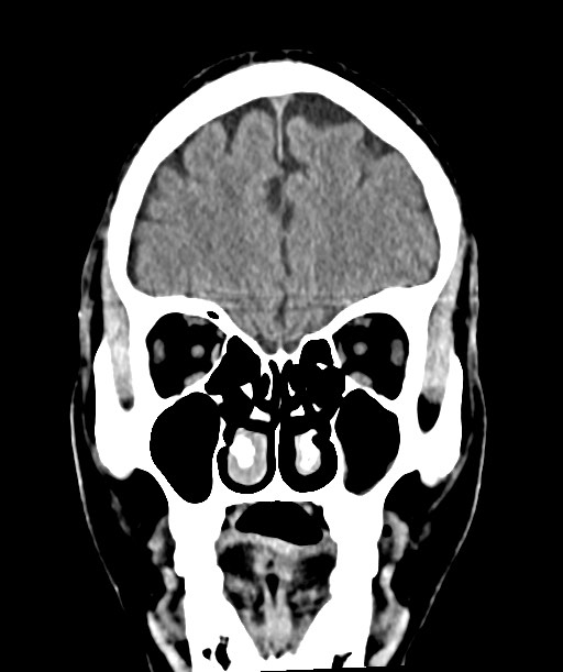 Chronic osteomyelitis - calvarial (severe) (Radiopaedia 69668-79616 Coronal non-contrast 19).jpg