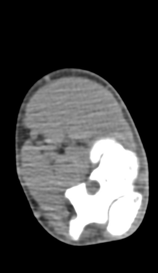 Chronic osteomyelitis of the distal humerus (Radiopaedia 78351-90971 Axial non-contrast 96).jpg