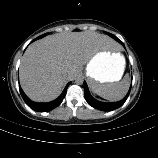Chronic pancreatitis (Radiopaedia 64576-73450 Axial non-contrast 17).jpg
