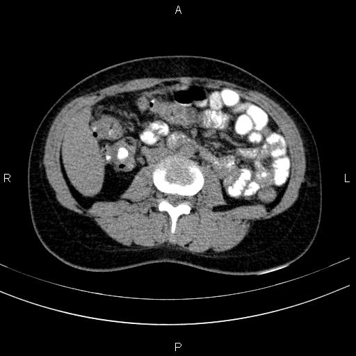 Chronic pancreatitis (Radiopaedia 64576-73450 Axial non-contrast 83).jpg