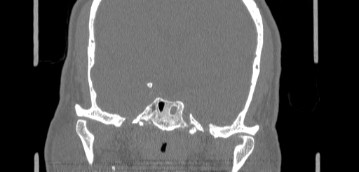 Chronic sphenoidal sinusitis (Radiopaedia 62030-70122 Coronal bone window 136).jpg