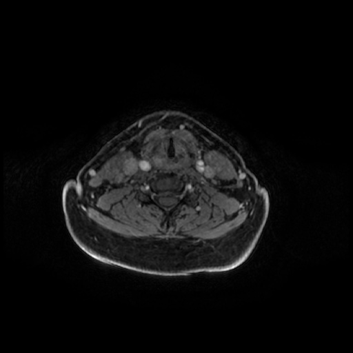 Chronic submandibular sialadenitis (Radiopaedia 61852-69885 Axial T1 C+ fat sat 24).jpg