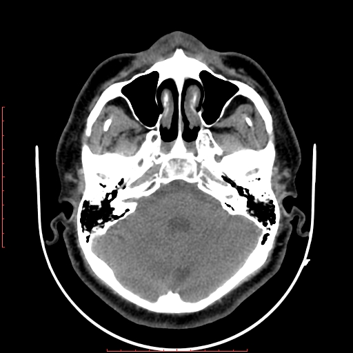 Chronic submandibular sialolithiasis (Radiopaedia 69817-79814 Axial non-contrast 3).jpg