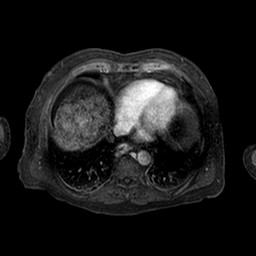 Cirrhosis and hepatocellular carcinoma in the setting of hemochromatosis (Radiopaedia 75394-86594 Axial T1 C+ fat sat 247).jpg