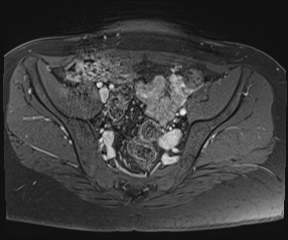 File:Class II Mullerian duct anomaly- unicornuate uterus with rudimentary horn and non-communicating cavity (Radiopaedia 39441-41755 Axial T1 fat sat 35).jpg
