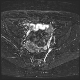 File:Class II Mullerian duct anomaly- unicornuate uterus with rudimentary horn and non-communicating cavity (Radiopaedia 39441-41755 Axial T2 fat sat 13).jpg