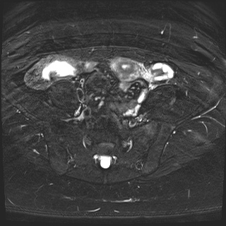 File:Class II Mullerian duct anomaly- unicornuate uterus with rudimentary horn and non-communicating cavity (Radiopaedia 39441-41755 Axial T2 fat sat 6).jpg