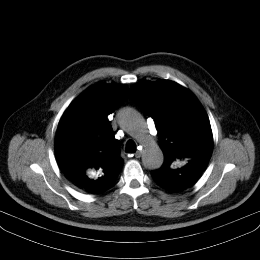File:Classic complicated silicosis (Radiopaedia 49720-54961 Axial liver window 18).jpg