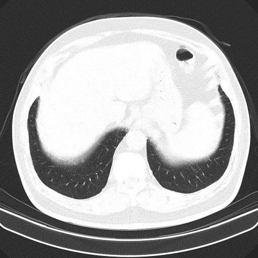 File:Classic complicated silicosis (Radiopaedia 49720-54961 Axial lung window 52).jpg