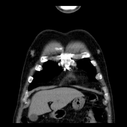File:Classic complicated silicosis (Radiopaedia 49720-54961 Coronal liver window 3).jpg