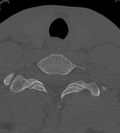 Clay-shoveler fracture (Radiopaedia 14604-14532 Axial bone window 41).jpg