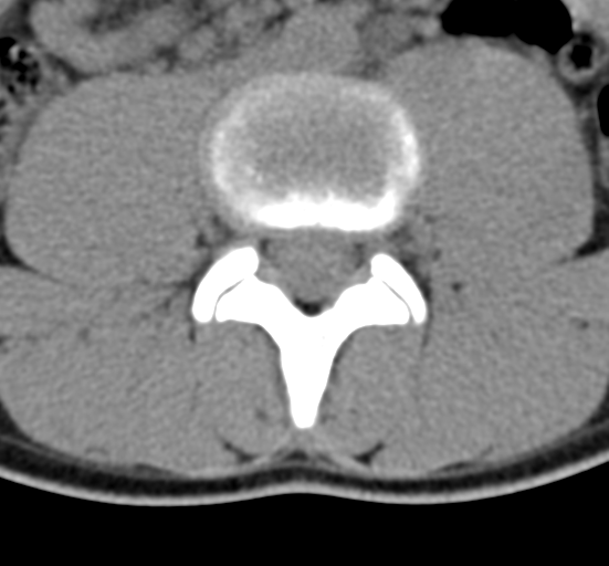 Clear cell meningoma - lumbar spine (Radiopaedia 60116-67691 Axial non-contrast 45).png