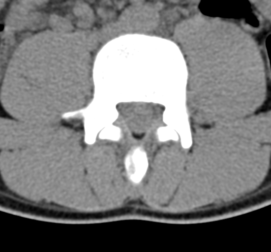Clear cell meningoma - lumbar spine (Radiopaedia 60116-67691 Axial non-contrast 47).png