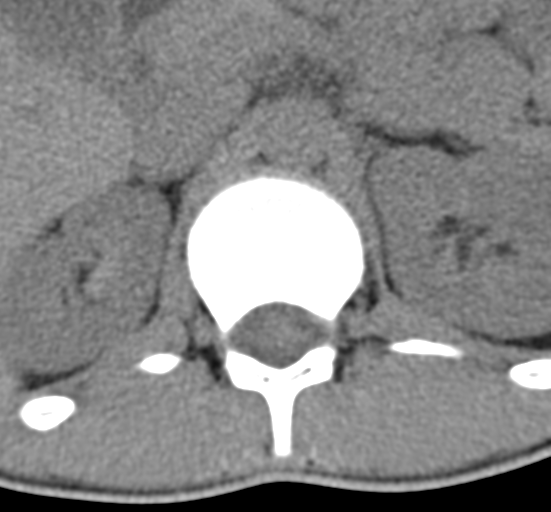 Clear cell meningoma - lumbar spine (Radiopaedia 60116-67691 Axial non-contrast 6).png