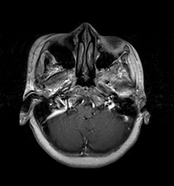 File:Clival meningioma (Radiopaedia 53278-59248 Axial T1 C+ 2).jpg