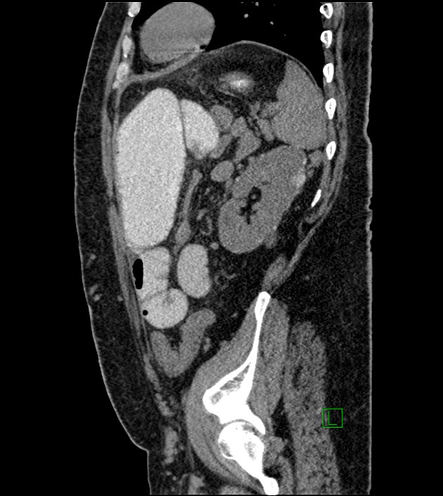 Closed-loop small bowel obstruction-internal hernia (Radiopaedia 78439-91096 C 44).jpg