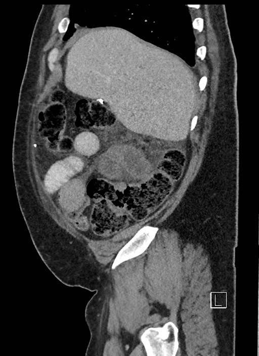 Closed loop obstruction - internal hernia into nephrectomy bed (Radiopaedia 59867-67320 C 89).jpg