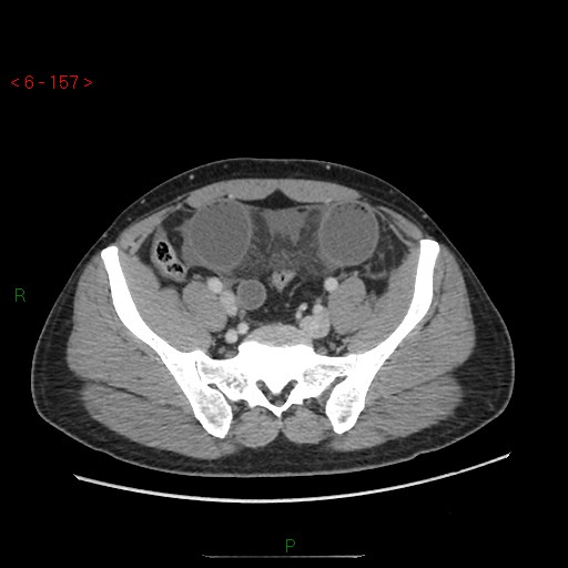 Closed loop obstruction and appendicular stump mucocele (Radiopaedia 54014-60163 A 93).jpg