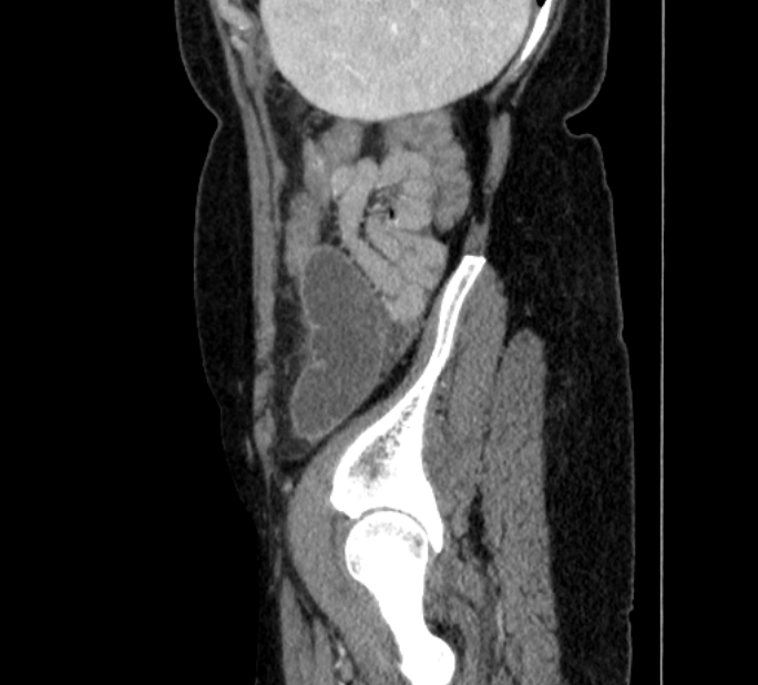 Closed loop small bowel obstruction (Radiopaedia 71211-81508 C 145).jpg