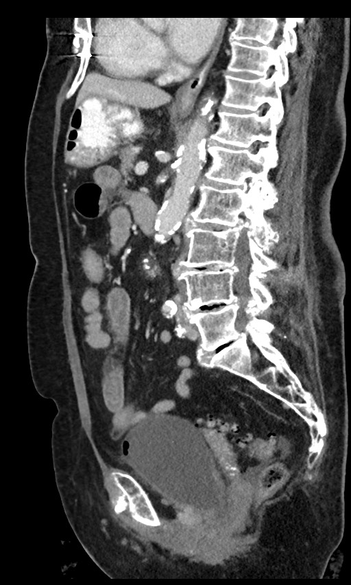 Closed loop small bowel obstruction - adhesions (Radiopaedia 59269-66611 C 53).jpg