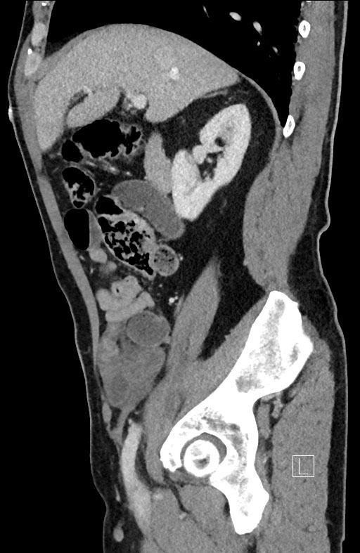 Closed loop small bowel obstruction - internal hernia (Radiopaedia 57806-64778 C 77).jpg