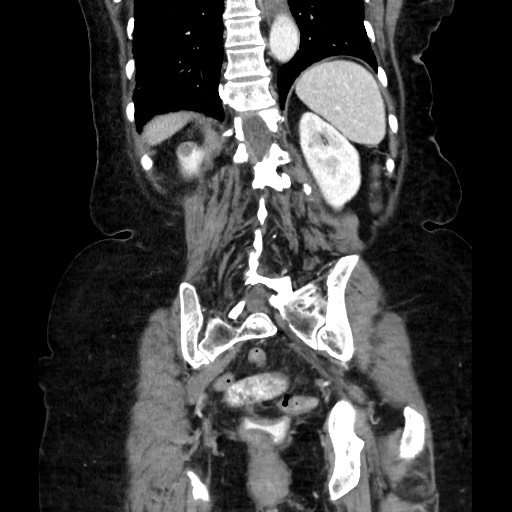 Closed loop small bowel obstruction due to adhesive band, with intramural hemorrhage and ischemia (Radiopaedia 83831-99017 C 94).jpg