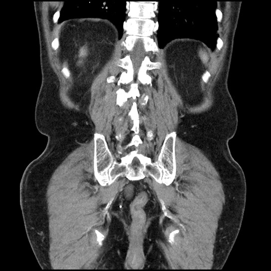 Closed loop small bowel obstruction due to adhesive band - U-shaped loop (Radiopaedia 83829-99012 B 41).jpg