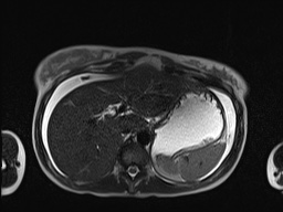 File:Closed loop small bowel obstruction in pregnancy (MRI) (Radiopaedia 87637-104031 Axial T2 15).jpg