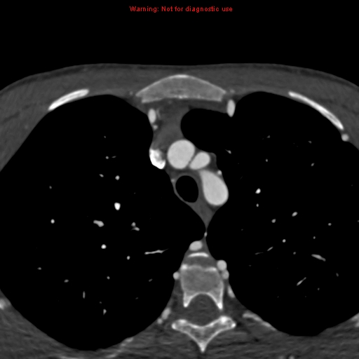 File:Coarctation of the aorta (Radiopaedia 12461-12697 A 27).jpg