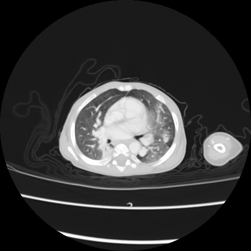 Coarctation of the aorta and patent ductus arteriosus (Radiopaedia 68033-77499 Axial lung window 25).jpg