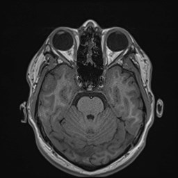 Cochlear incomplete partition type III associated with hypothalamic hamartoma (Radiopaedia 88756-105498 Axial T1 74).jpg