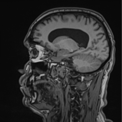 File:Colloid cyst of the third ventricle (Radiopaedia 86571-102662 Sagittal T1 49).png