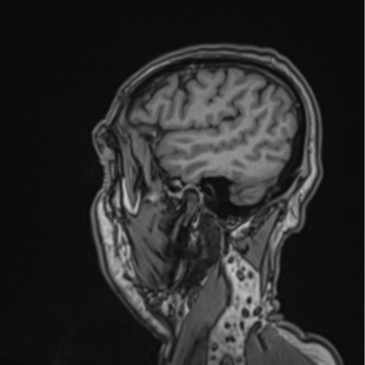 Colloid cyst of the third ventricle (Radiopaedia 86571-102662 Sagittal T1 64).png