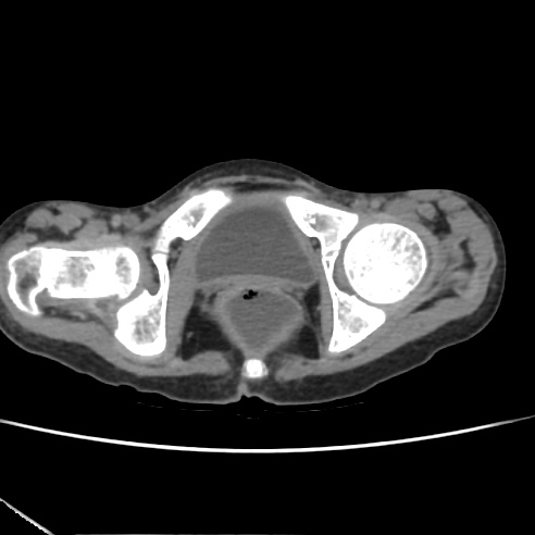File:Colocolic fistula - Crohn disease (Radiopaedia 57063-63955 A 91).jpg