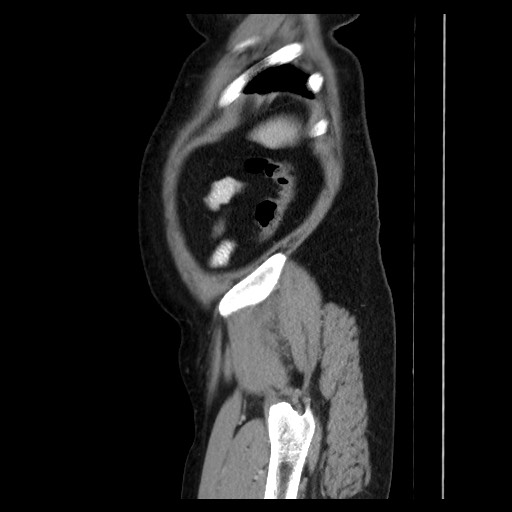 Colocolic intussusception due to tubular adenoma (Radiopaedia 73744-84551 C 136).jpg